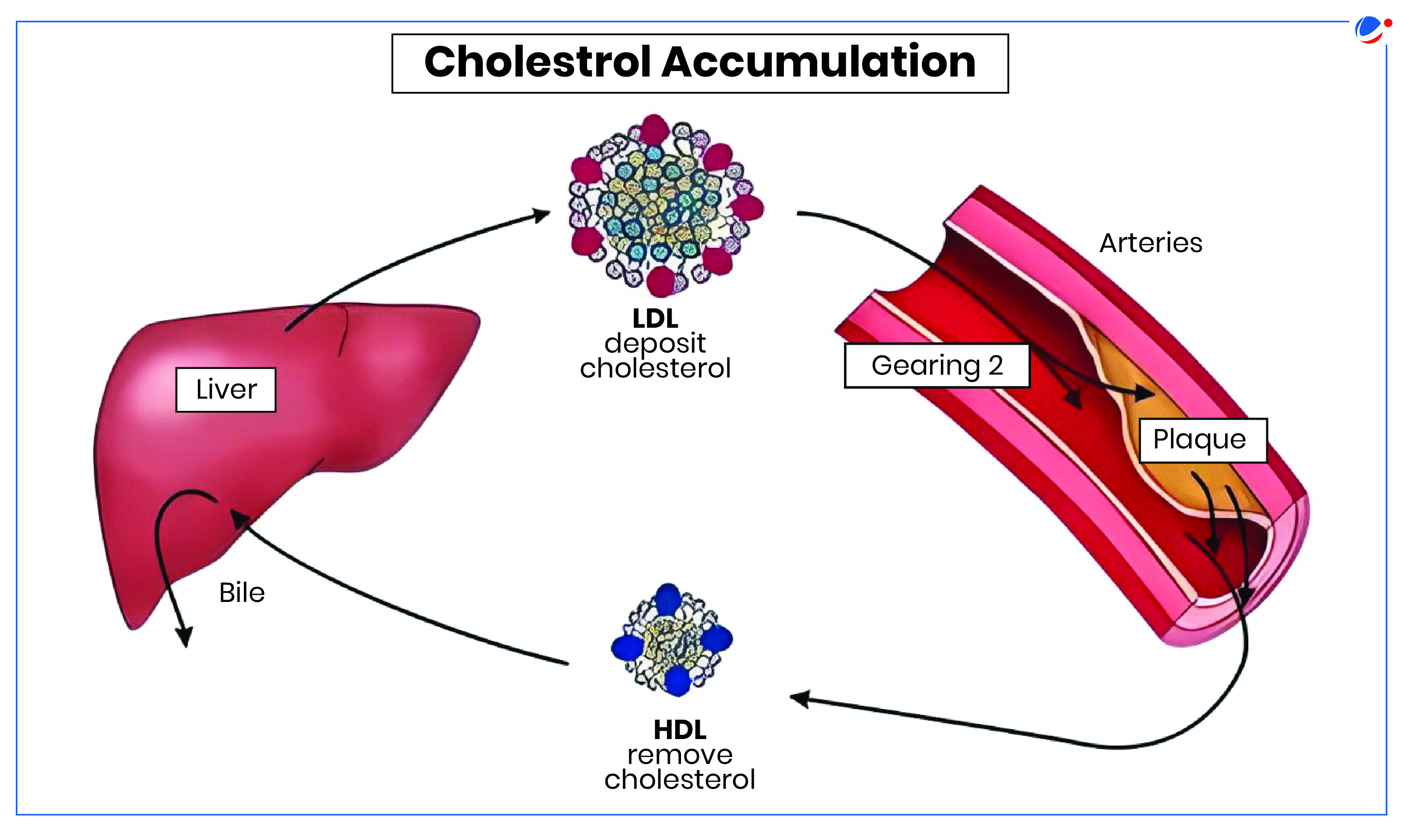 A diagram showing cholesterol accumulation. LDL deposits cholesterol from the liver to the arteries, forming plaque. HDL removes cholesterol, transporting it back to the liver. Arrows indicate the flow of cholesterol between the liver, arteries, and bile.